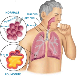 obat tradisional penyakit bronkitis kronis